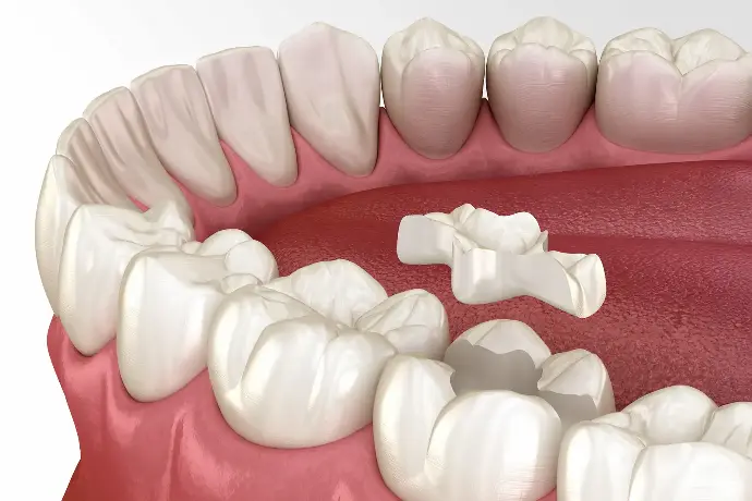 Cure conservative dentali